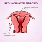 PEDUNCULATED FIBROID
