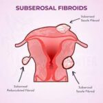 SUBSEROSAL FIBROID