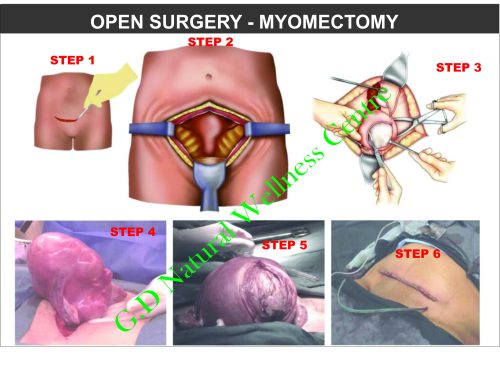 FIB SURGERY DESIGN